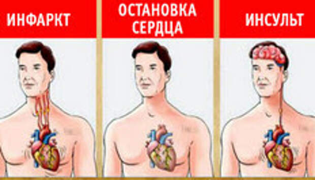 В чем разница между инсультом, инфарктом и остановкой сердца? Это должен знать каждый!