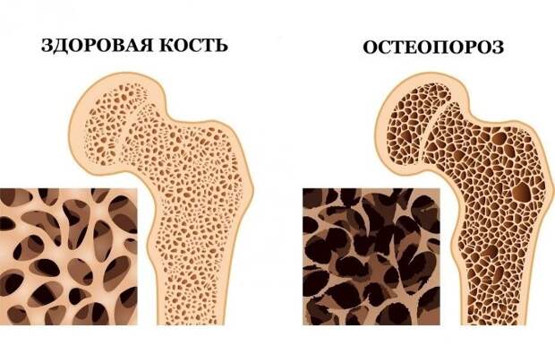 Можно ли обратить остеопороз вспять : что важно знать?