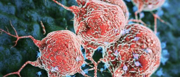 Разработан наиболее эффективный в мире метод лечения опухолей