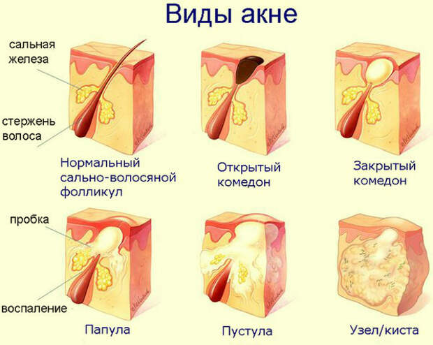 как вылечить акне