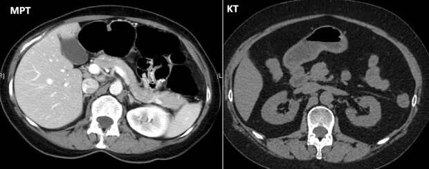 МРТ (магнитно-резонансная томография) брюшной полости