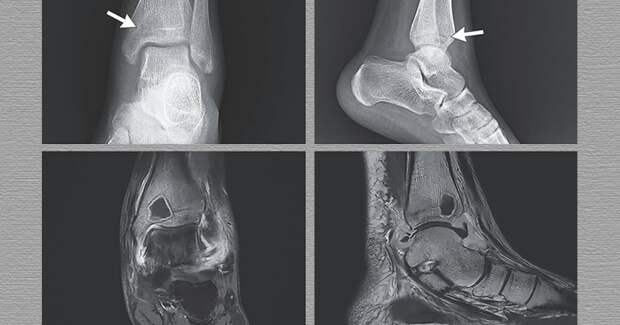 Сальмонелла вызвала внутрикостный абсцесс у 16‑летней китаянки