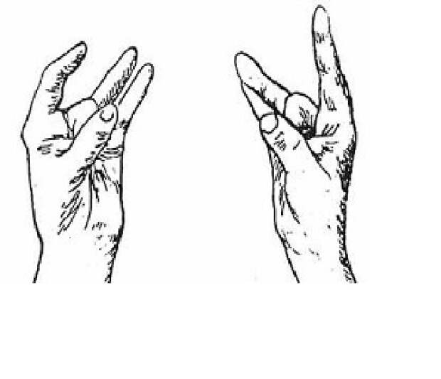 3. При ушных заболеваниях и осложнении слуха Способность пальцев, медицина