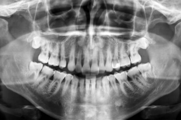 Рентген челюстной области