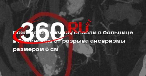 Пожилого мужчину спасли в больнице в Раменском от разрыва аневризмы размером 6 см