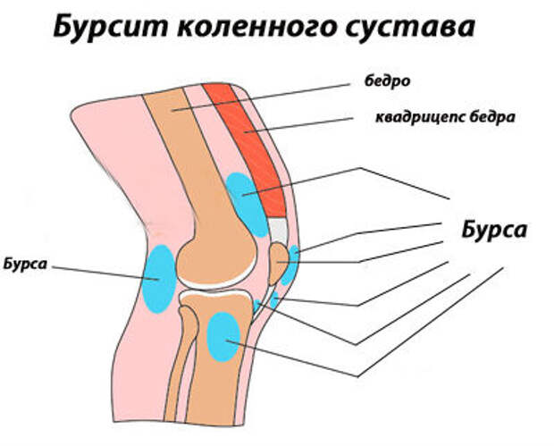 bursit-kolennogo-sustava2