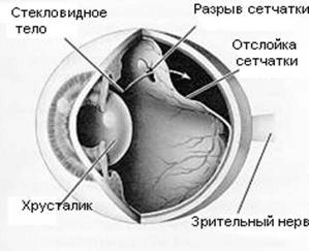 Отслоение задней стенки стекловидного тела глаза лечение