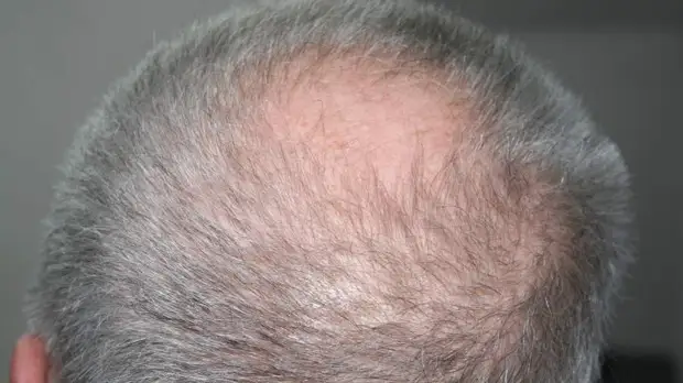 Долгая болезнь: как бороться с последствиями коронавируса