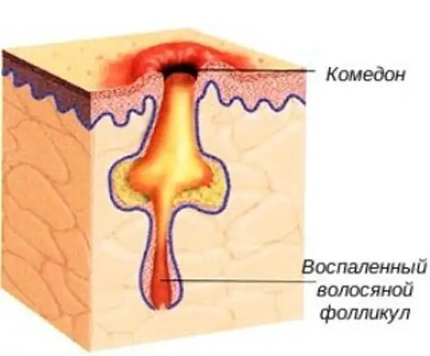 Комедоны На Коже Фото