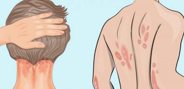 Psoriasis-Causes-Symptoms-and-The-Vitamin-You’re-Missing