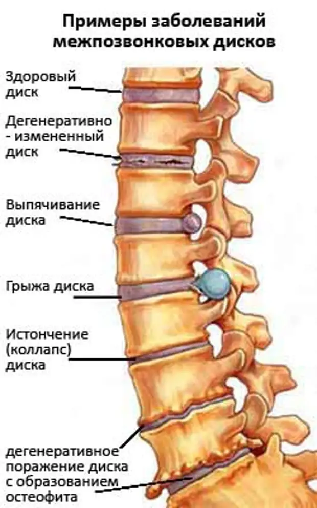 Остеохондроз на картинке