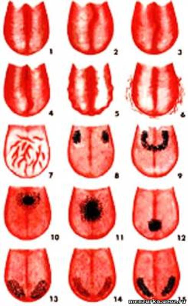 Определение болезни по языку в картинках диагноз. Гипопластический глоссит. Эксфолиативный глоссит.