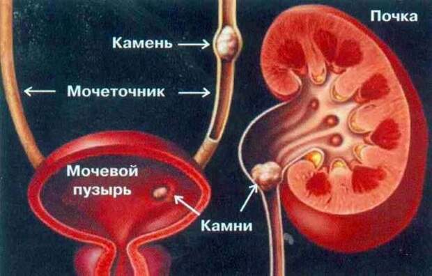 как вывести камни из почек
