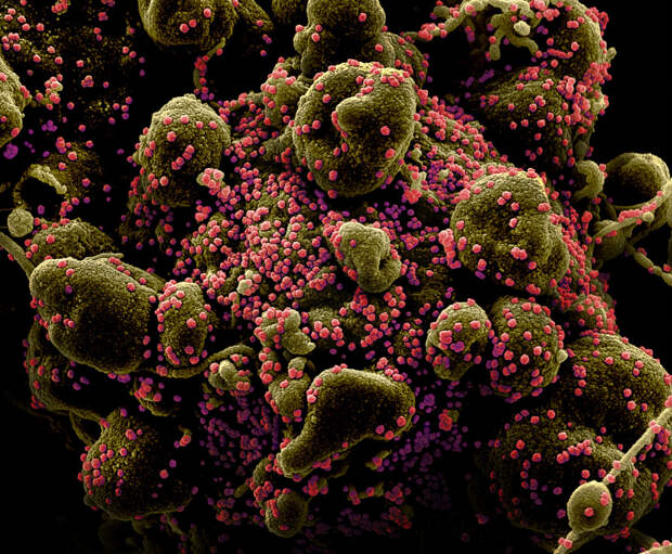 Клетка (зеленая) в окружении вирионов SARS-CoV-2 (розовые). Многочисленные выросты клетки говорят о том, что она находится на конечной стадии апоптоза — программируемой клеточной смерти — и скоро будет фрагментирована. Заражение клетки вирусом — один из поводов для апоптоза. Раскрашенная фотография, полученная с помощью сканирующего электронного микроскопа, с сайта npr.org