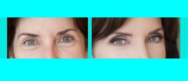 Затемнение внешних уголков глаз при глубоко посаженных глазах может визуально состарить