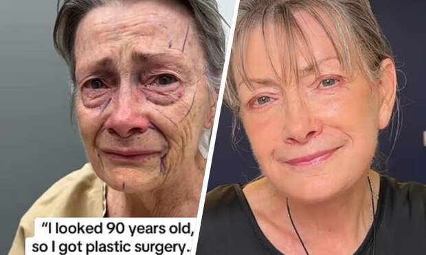 70-летняя женщина решилась на пластику лица, и фото после нее действительно впечатляют