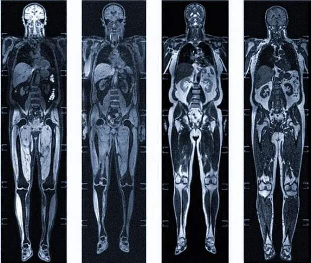 МРТ всего тела для скрининга рака: Полное руководство