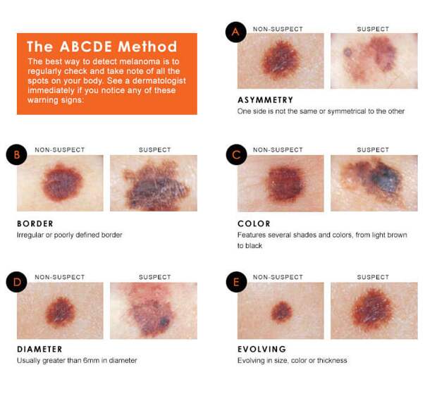 Эту таблицу еще называют АВСDE РОДИНКИ, важное, детектор, здоровые, интересное, меланома, рак кожи