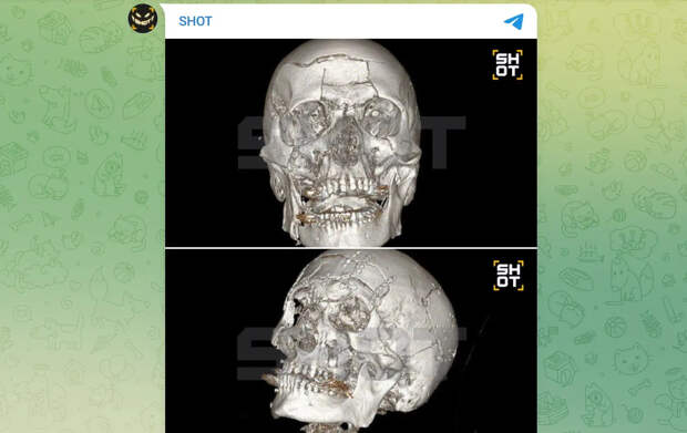 В Жуковском мужчина раскрошил всё лицо из-за падения со снегохода