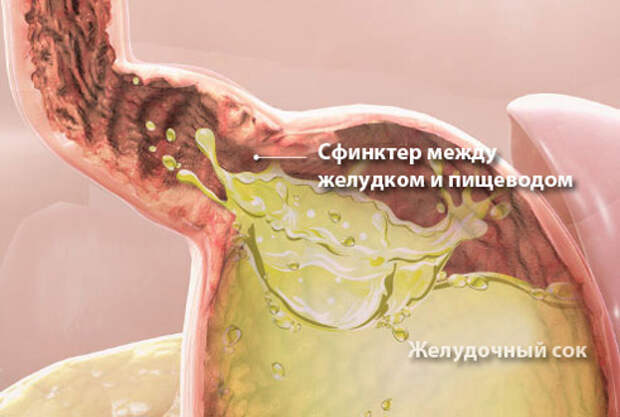 лечение изжоги