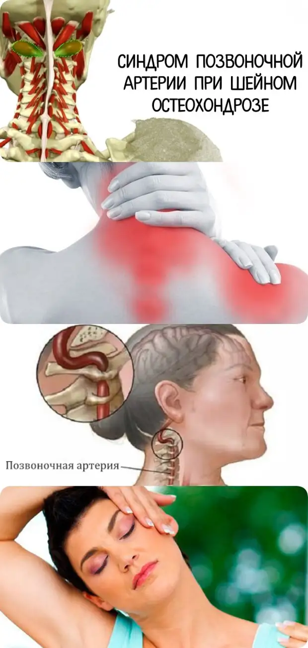 Синдром позвоночника. Массаж при синдроме позвоночной артерии при шейном остеохондрозе. Синдром артерии позвоночника шейного. Шея при остеохондрозе. Остеохондроз шейного отдела фото.