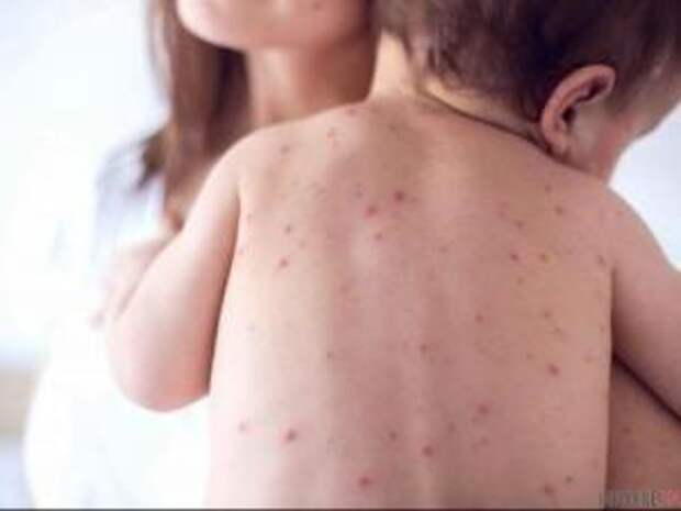 В Харьковской области снова растет заболеваемость корью