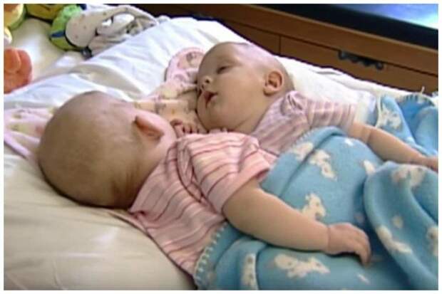 Эбби и Изабель Карлсон близнецы сиамские, бывает же, выросли, жизнь, интересное, разделили