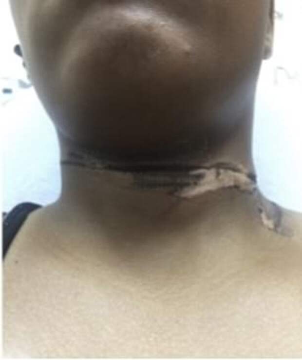 Она получила ожог после того, как зарядка от iPhone коснулась ожерелья на ее шее