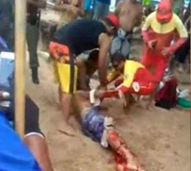 В Бразилии акула напала на туриста - он лишился ноги и впал в кому