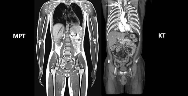 Компьютерная томография (КТ) всего тела