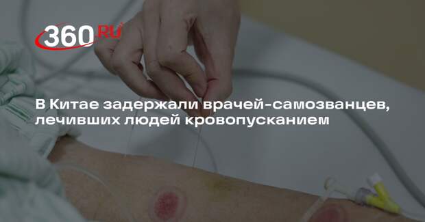 В Китае задержали врачей-самозванцев, лечивших людей кровопусканием