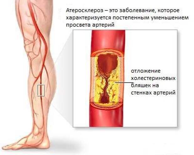 Атеросклероз магистральных артерий конечностей