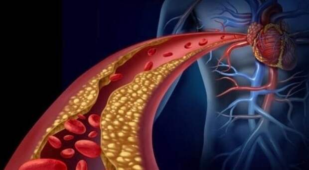 КАК БОРОТЬСЯ С ПЛОХИМ ХОЛЕСТЕРИНОМ
