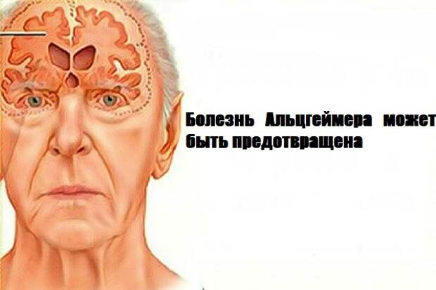 Alzheimers-Disease