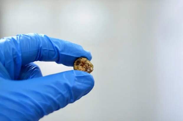 Желчные камни (холелитиаз) - от "немых" находок до опасных приступов. Симптомы, диагностика, лечение