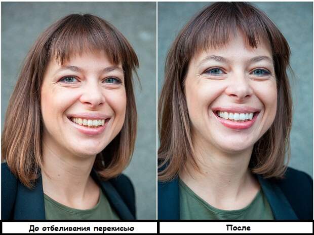 Отбеливать зубы перекисью можно не чаще раза в неделю Отбеливать зубы перекисью можно не чаще раза в неделю