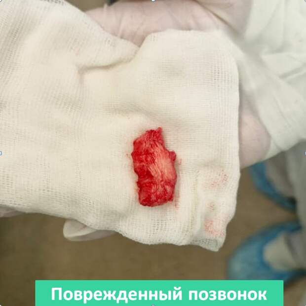 В конце апреля в нейрохирургическое отделение в ФГБУ «Государственный научный центр — Федеральный медицинский биофизический центр им. А.И. Бурназяна» ФМБА России поступил пациент с жалобами на сильную боль в шее. Результаты МРТ показали картину патологического перелома основания зубовидного отростка С2 со смещением, подвывиха. Причиной стал развившийся там метастатический процесс — в 2022 году у мужчины диагностировали рак с метастазами. Тогда пациент прошел химиотерапевтическое лечение и вышел в ремиссию. Спустя год случился рецидив, один из метастазов образовался в позвонке.