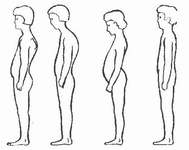 Неправильная осанка. Искривление позвоночника сутулость. Лордоз кифоз сколиоз. Нарушение осанки сутулость. Нарушение осанки сколиоз сутулость.