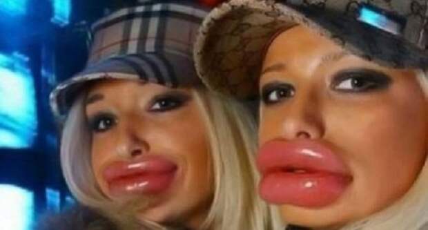 неудачное увеличение губ