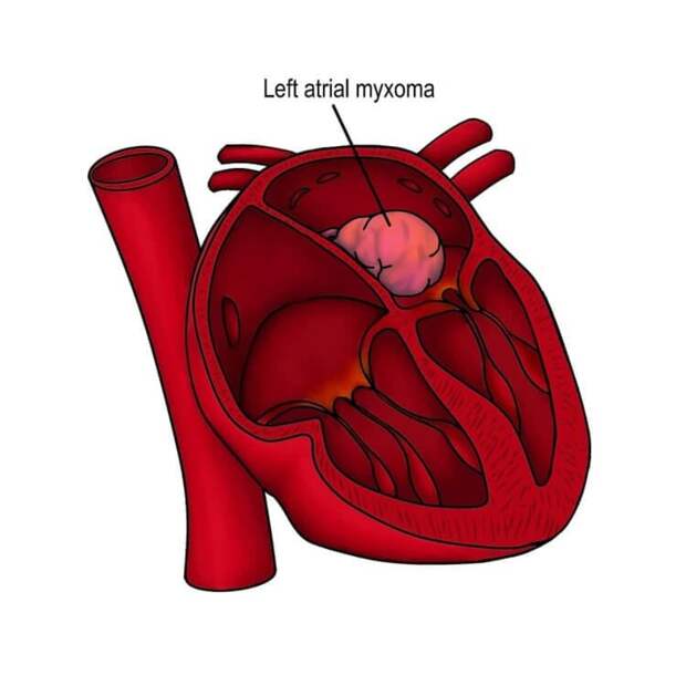 Какие бывают опухоли на сердце. Миксома в сердце. Фото.