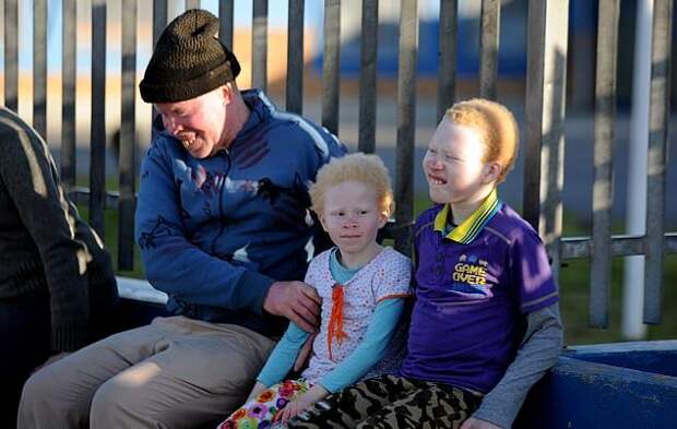 Семья альбиносов из ЮАР вынуждена жить в страхе перед охотниками за частями их тел