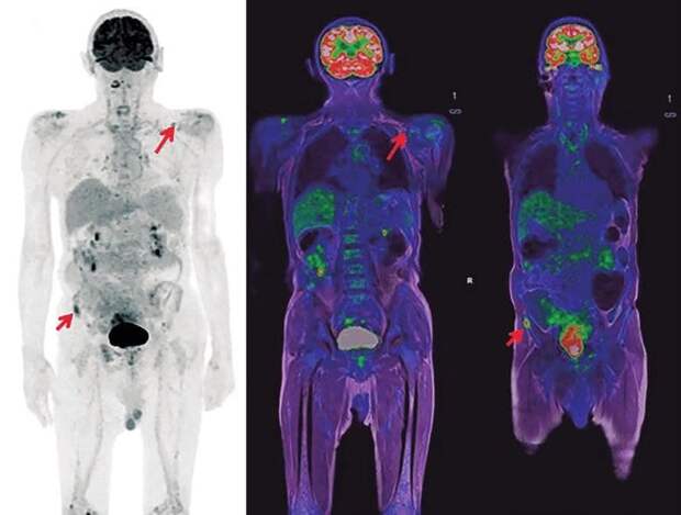 ПЭТ-КТ и МРТ: два столпа современной онкологии. В чем разница и когда их комбинируют