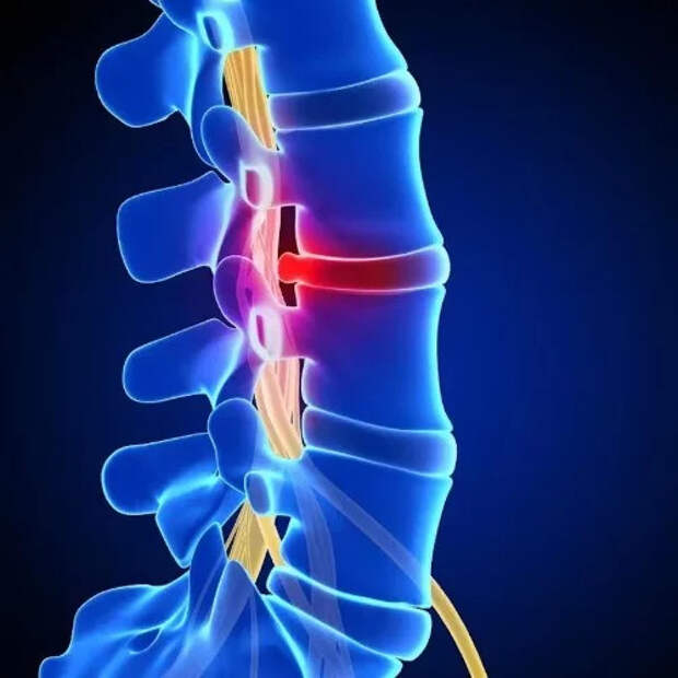 Симптомы протрузии межпозвонковых дисков
