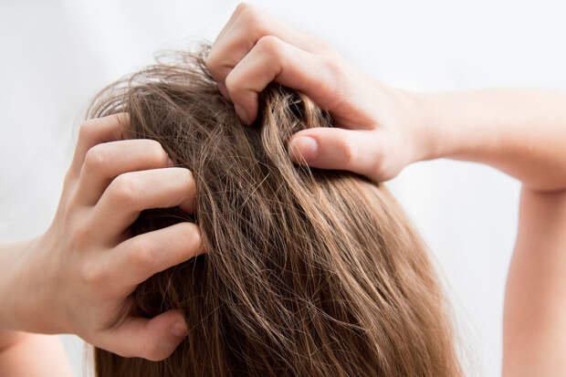 Трихолог Гончарова: долгое наличие перхоти может перерасти в себорейный дерматит
