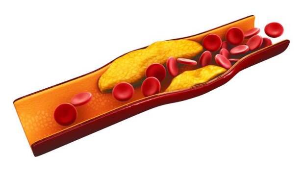 Снижение уровня холестерина: какие продукты есть и уменьшить, чтобы снизить высокий уровень холестерина