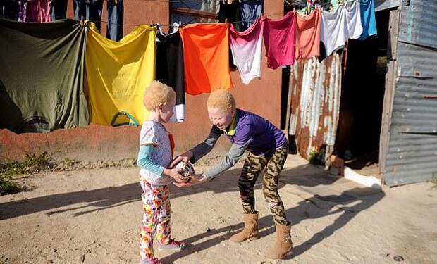 Семья альбиносов из ЮАР вынуждена жить в страхе перед охотниками за частями их тел