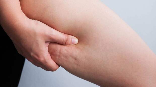 Борьба с «апельсиновой коркой»: можно ли с помощью массажа убрать целлюлит