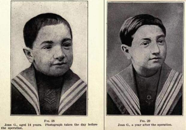 14-летний мальчик до и после того, как ему пересадили щитовидную железу шимпанзе. Фото: en.wikipedia.org.