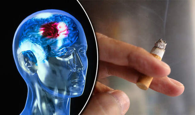 Микроинсульт: причины, симптомы, диагностика, лечение, восстановление