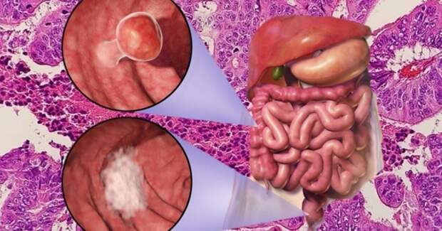 Кокрейновский обзор поставил под сомнение профилактическую роль аспирина при колоректальном раке